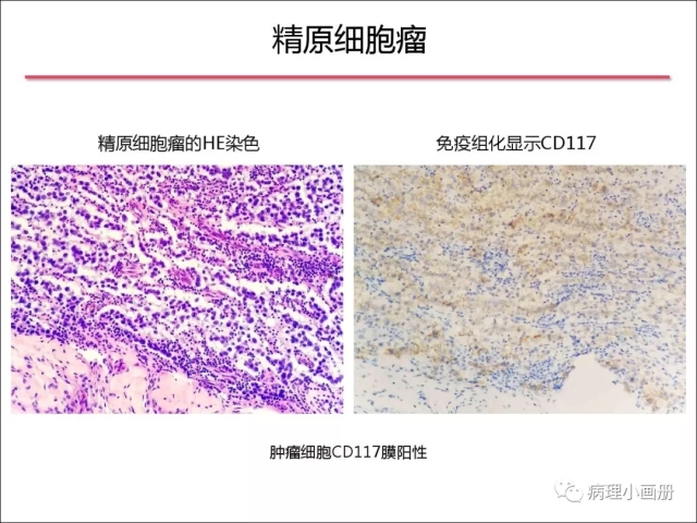 泌尿病理--精原细胞瘤VS精母细胞瘤