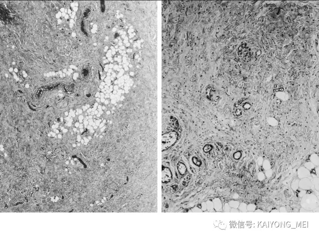 女性生殖道软组织肿瘤病理诊断及进展（一）