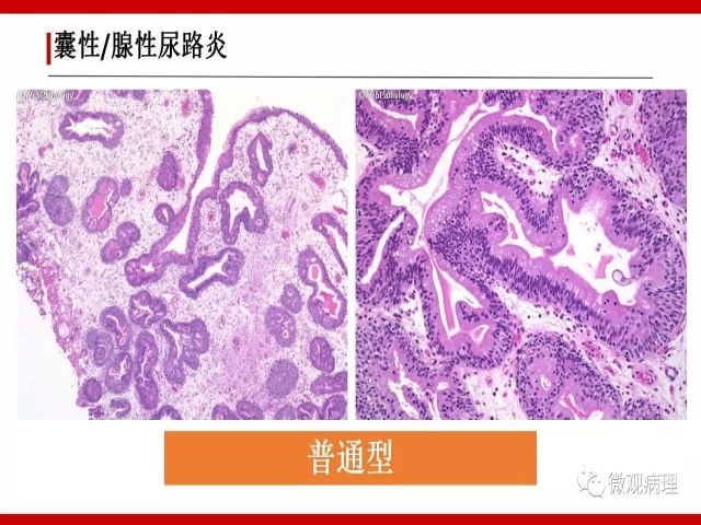 泌尿课程/尿路腺样病变的诊断要点
