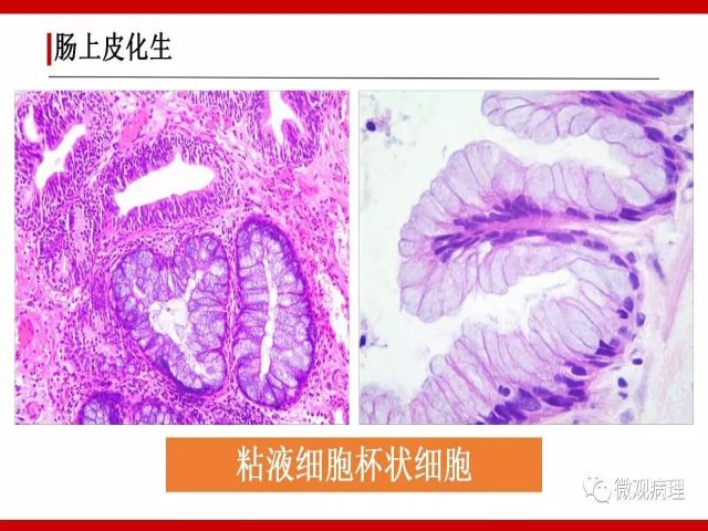 泌尿课程/尿路腺样病变的诊断要点