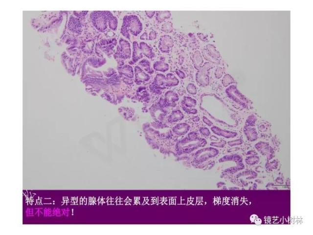 上消化道早癌病理的学习心得体会（附胃牵手癌的病例特点文献学习）