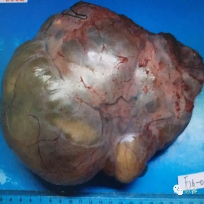 低级别黏液性肿瘤转移到卵巢伴腹腔假黏液瘤形成【小车】分享；【刘从容】老师讲解