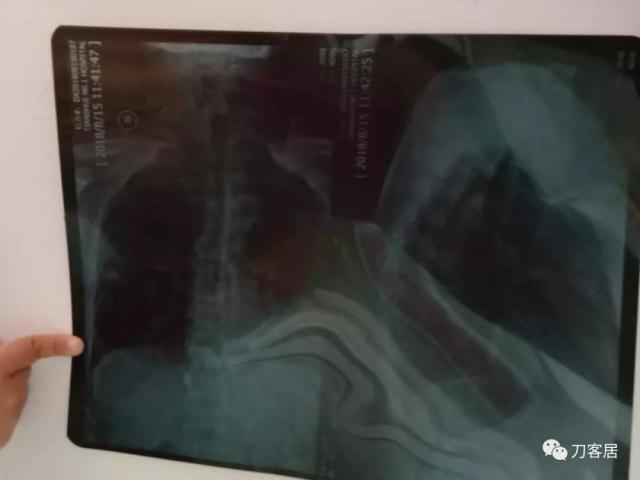 医生及患者通用:如何用手机翻拍X线片,磁共振片子,CT片子进行网络求医、病例讨论及保留资料 医生及患者通用:如何用手机翻拍X线片,磁共振片子,CT片子进行网络求医、病例讨论及保留资料