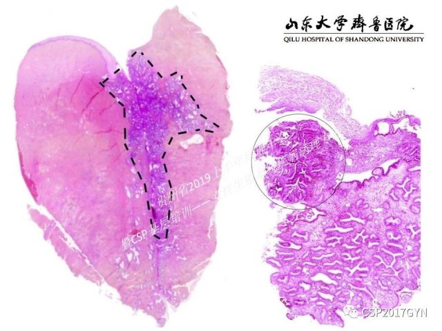 中华病理学会基层培训遵义站讲座（四）——宫颈腺癌的诊断及新分型