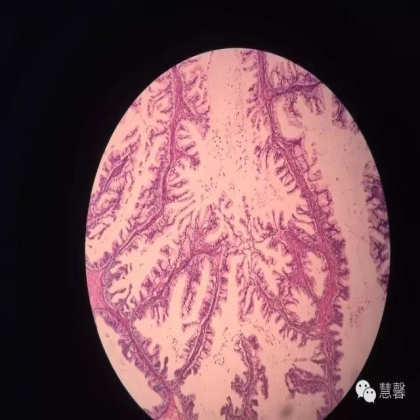 交界性黏液性囊腺瘤？癌？（魏娉分享，刘从容老师讲解）