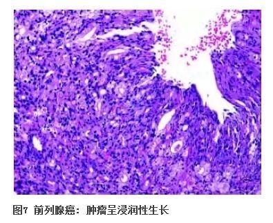 前列腺疾病的免疫组化诊断