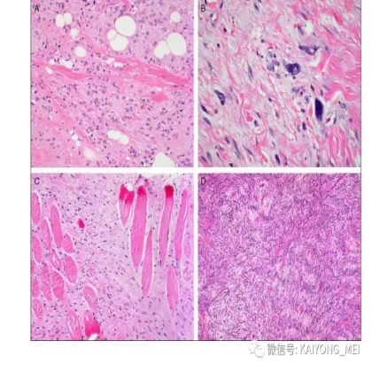 女性生殖道软组织肿瘤病理诊断及进展（二）