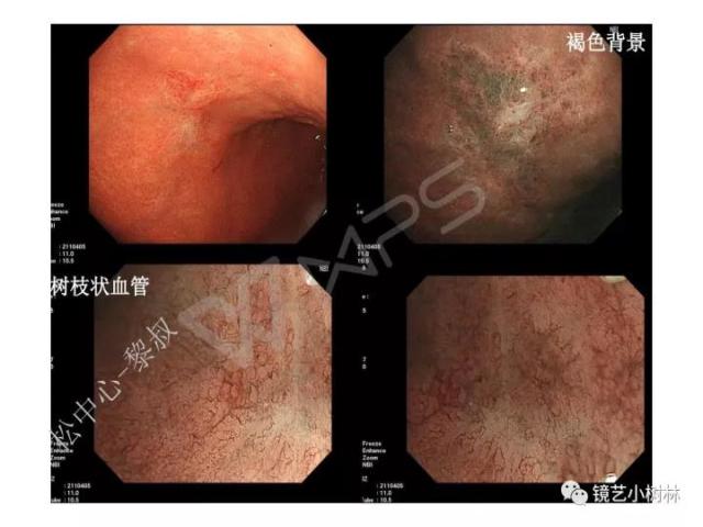 上消化道早癌病理的学习心得体会（附胃牵手癌的病例特点文献学习）