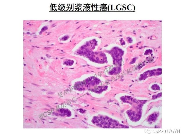 中华病理学会基层培训遵义站讲座（一）——卵巢和输卵管浆液性肿瘤的诊断和鉴别诊断