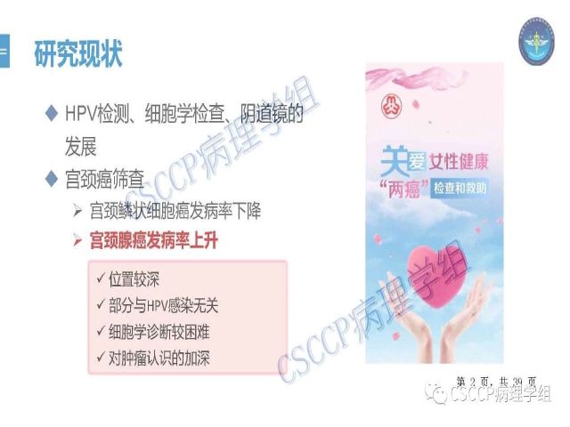 黄文亭 张询：宫颈腺癌分类介绍