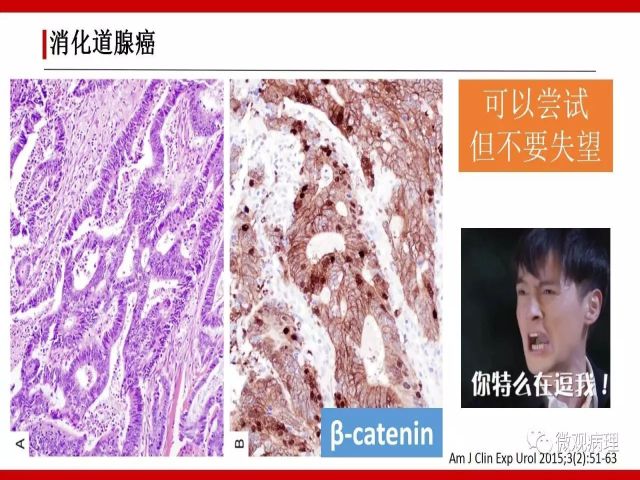泌尿课程/尿路腺样病变的诊断要点