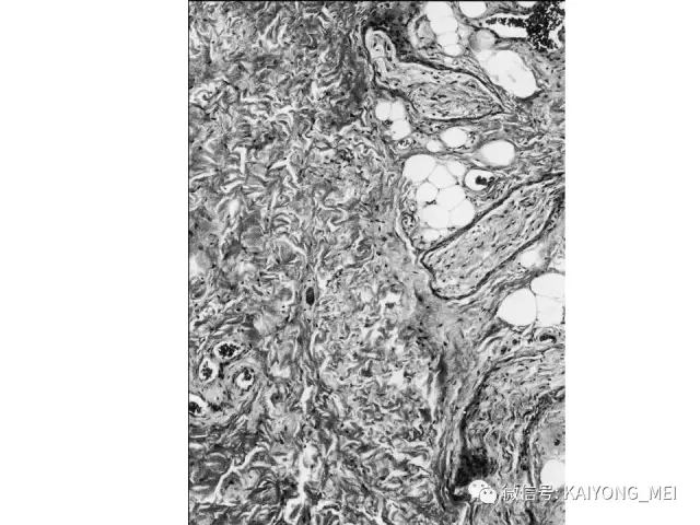 女性生殖道软组织肿瘤病理诊断及进展（一）