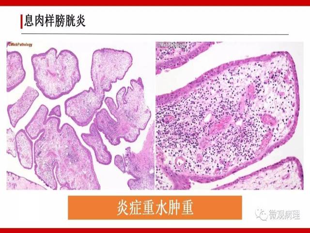 泌尿课程/非浸润性尿路上皮病变诊断的一些困惑