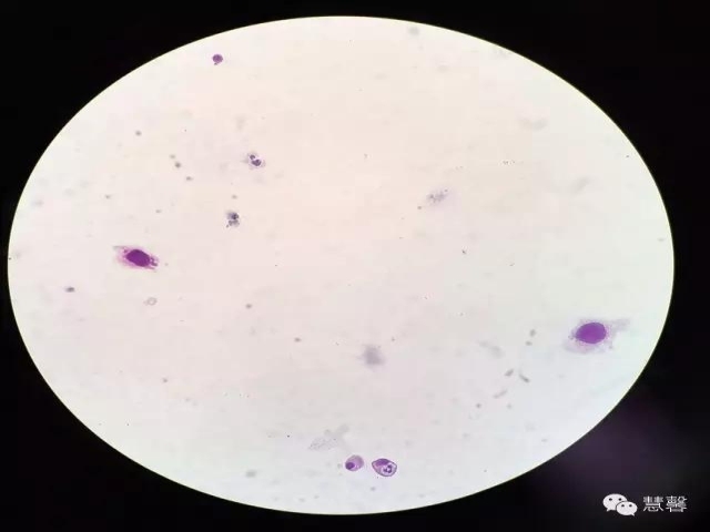 尿路上皮乳头状瘤、低级别尿路上皮乳头状癌的诊断及鉴别诊断，再听孔祥田(Max)*Roswell*NM老师讲解
