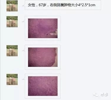 低分化支持－间质细胞瘤（ 戴敏病例分享，群友讨论，刘从容老师讲解）