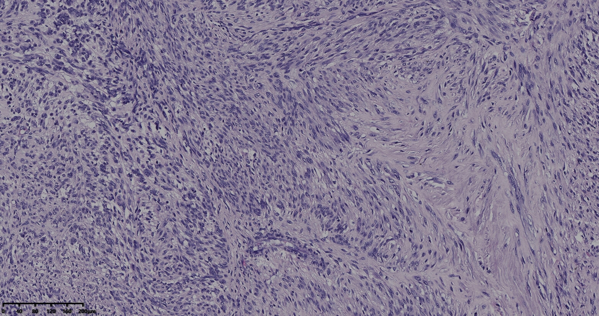 子宫多发性平滑肌瘤伴肉瘤