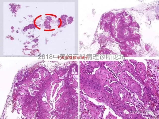 子宫内膜假肿瘤性病变及类似癌样病变