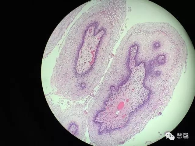阴道鳞状上皮乳头状瘤？尖锐湿疣？（孔祥田老师病例分享，粉蓝医疗科技（杭州）有限公司女性生殖2群讨论，孔祥田(Max)*Roswell*老师讲解）