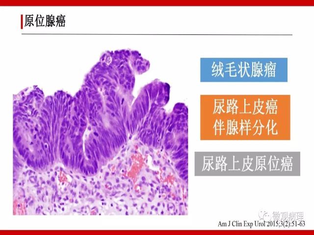 泌尿课程/尿路腺样病变的诊断要点