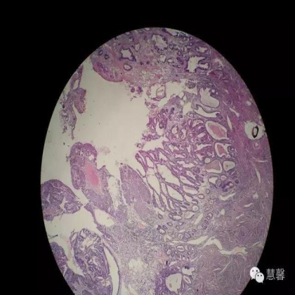 子宫内膜癌、宫内膜增殖症的鳞状分化、桑葚化生等问题（石岩分享，刘从容老师讲解）