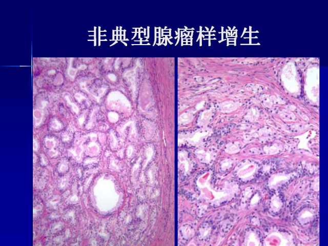 前列腺病理诊断线索（下）——黄教悌