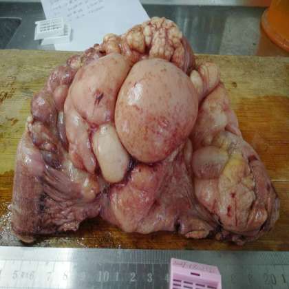 病理科工作札记（二十）小肠系膜脉管囊肿