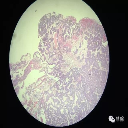 增殖性膀胱炎背景上的内翻性乳头状瘤（孔祥田(Max)*Roswell*NM]讲解）