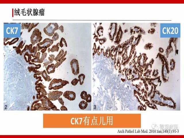 泌尿课程/尿路腺样病变的诊断要点