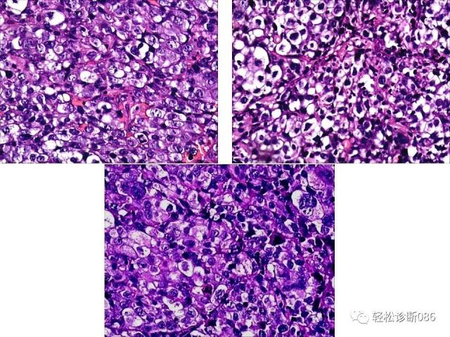 HIV/AIDS相关性LPDHIV感染相关淋巴瘤病例分析