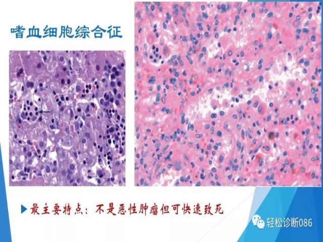 组织细胞来源疾病