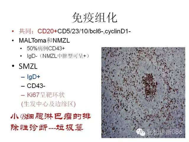 边缘区淋巴瘤（附小B细胞NHL鉴别诊断）