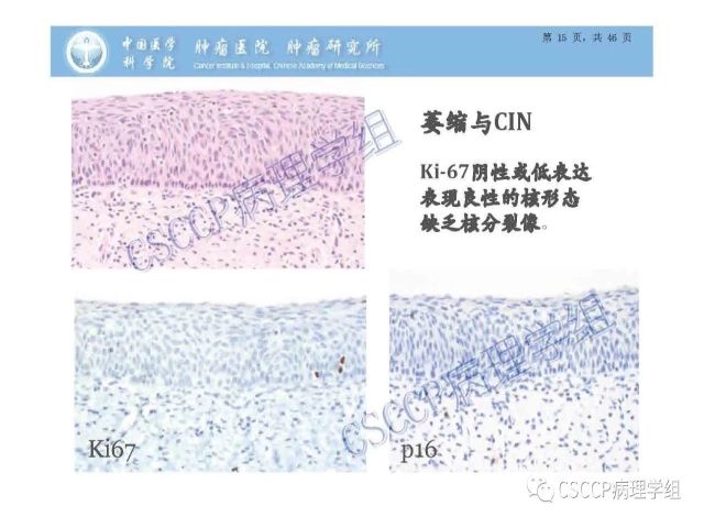 宫颈癌前病变中的诊断难点及阴道镜中ECC的 应用价值