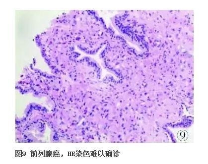 前列腺疾病的免疫组化诊断