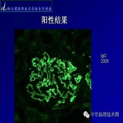探讨免疫组织学在肾穿标本中的应用