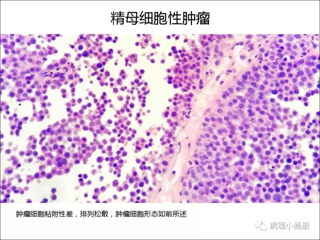 泌尿病理--精原细胞瘤VS精母细胞瘤