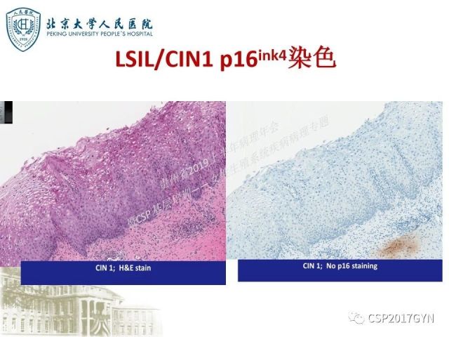 中华病理学会基层培训遵义站讲座（三）——宫颈鳞状上皮病变的病理诊断与鉴别诊断