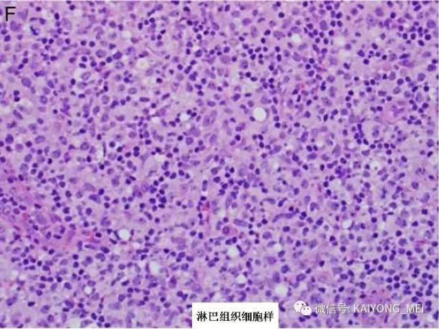 T细胞淋巴瘤病理诊断及进展（一）