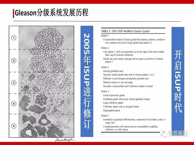 前列腺癌Gleason分级系统的前世今生