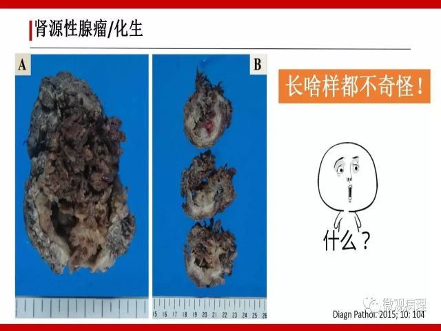 泌尿课程/尿路腺样病变的诊断要点