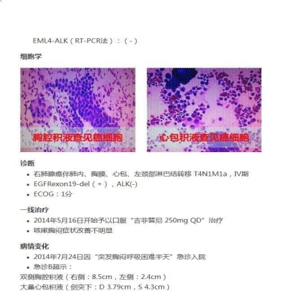 中日韩个体化诊疗案例大赛经典赏析之十——驱动基因双突变，两种靶向药物均无效，个体化治疗的阿克琉斯之踵