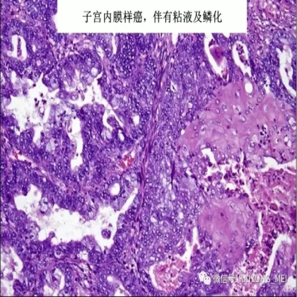 卵巢癌的病理诊断新进展（二）