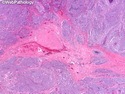 乳腺病理-乳腺癌-乳腺癌分子分型