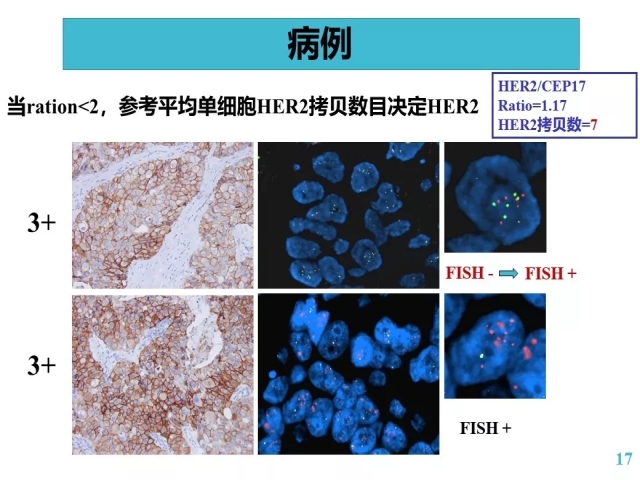 乳腺癌HER2检测指南更新