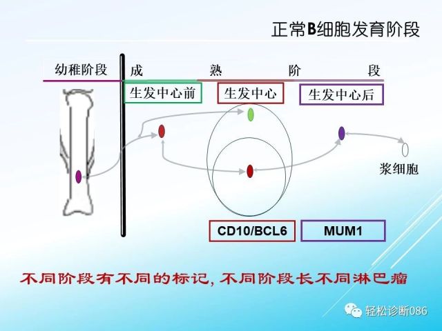 中枢神经系统弥漫大B细胞淋巴瘤