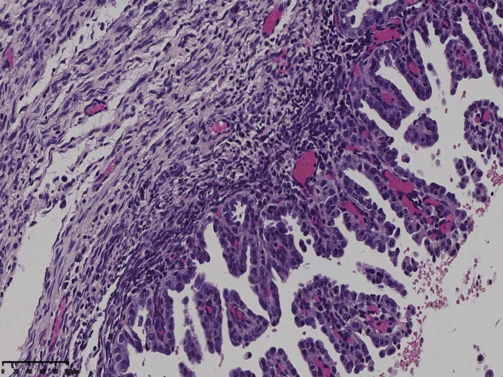 子宫透明细胞癌？