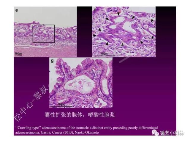上消化道早癌病理的学习心得体会（附胃牵手癌的病例特点文献学习）