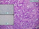 乳腺病理-乳腺癌-乳腺癌分子分型
