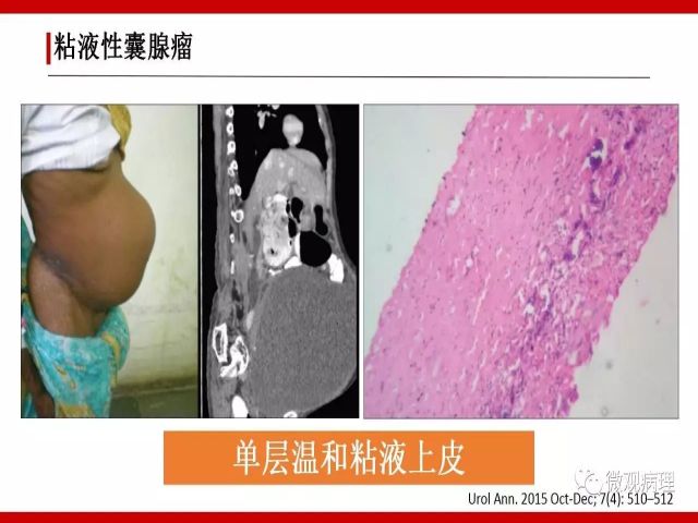 泌尿课程/尿路腺样病变的诊断要点