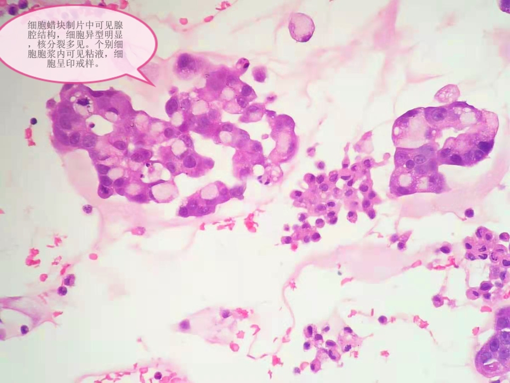 腹水转移癌，未找到原发灶——病理科工作札记（五十六）