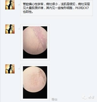 High grade nested variant Urothelial carcinoma(老胡分享，孔祥田老师讲解)
